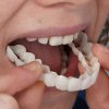 Snap-On-Smile dočasný zubný mostík